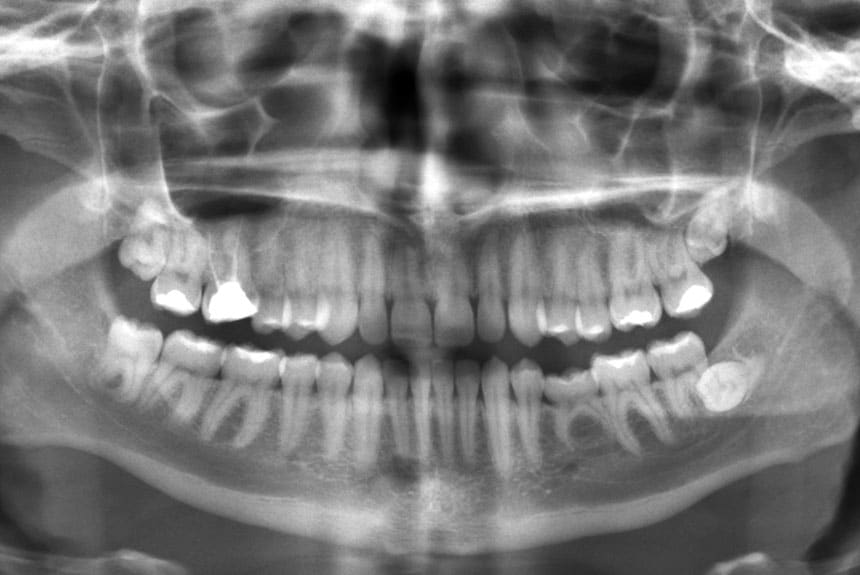Importance Of X-Rays: Seeing Your Teeth From The Inside