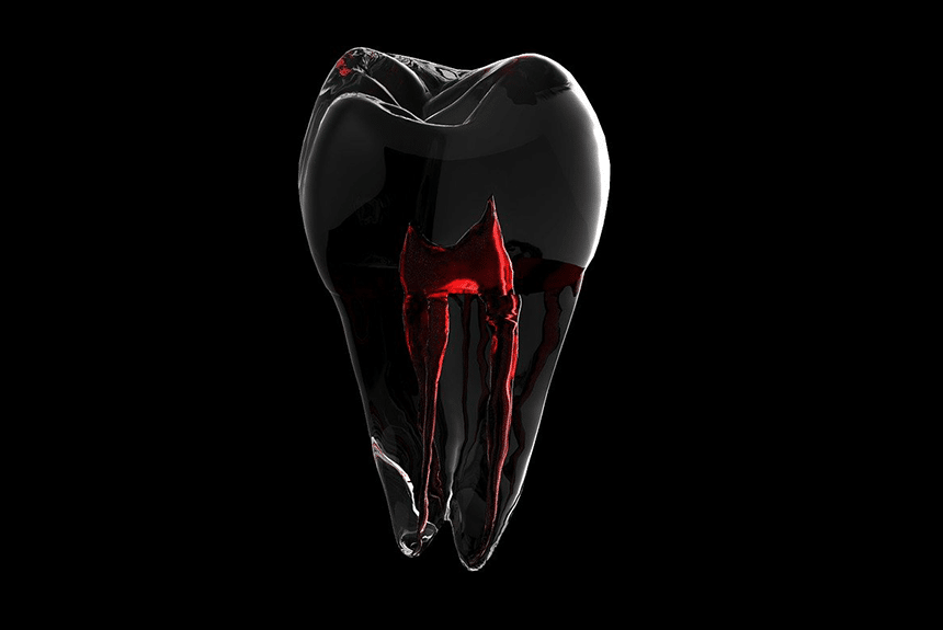 How Root Canals Can Help to Deal with Persistent Tooth Pain