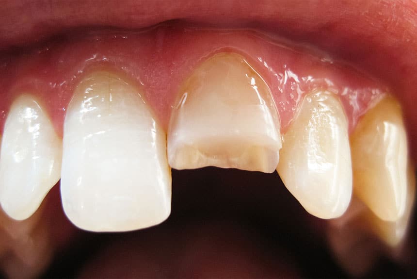 A cracked tooth in a mouth experienced during the COVID-19 pandemic
