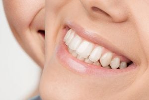 Veneers