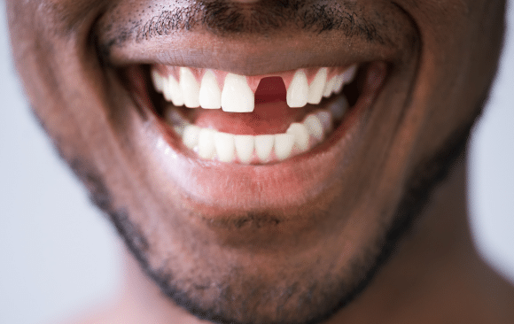 Missing Teeth in Barrie – Is there an alternative to dentures?