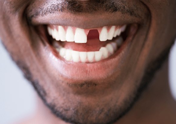 Missing Teeth in Barrie – Is there an alternative to dentures?