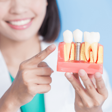 Dental Implants