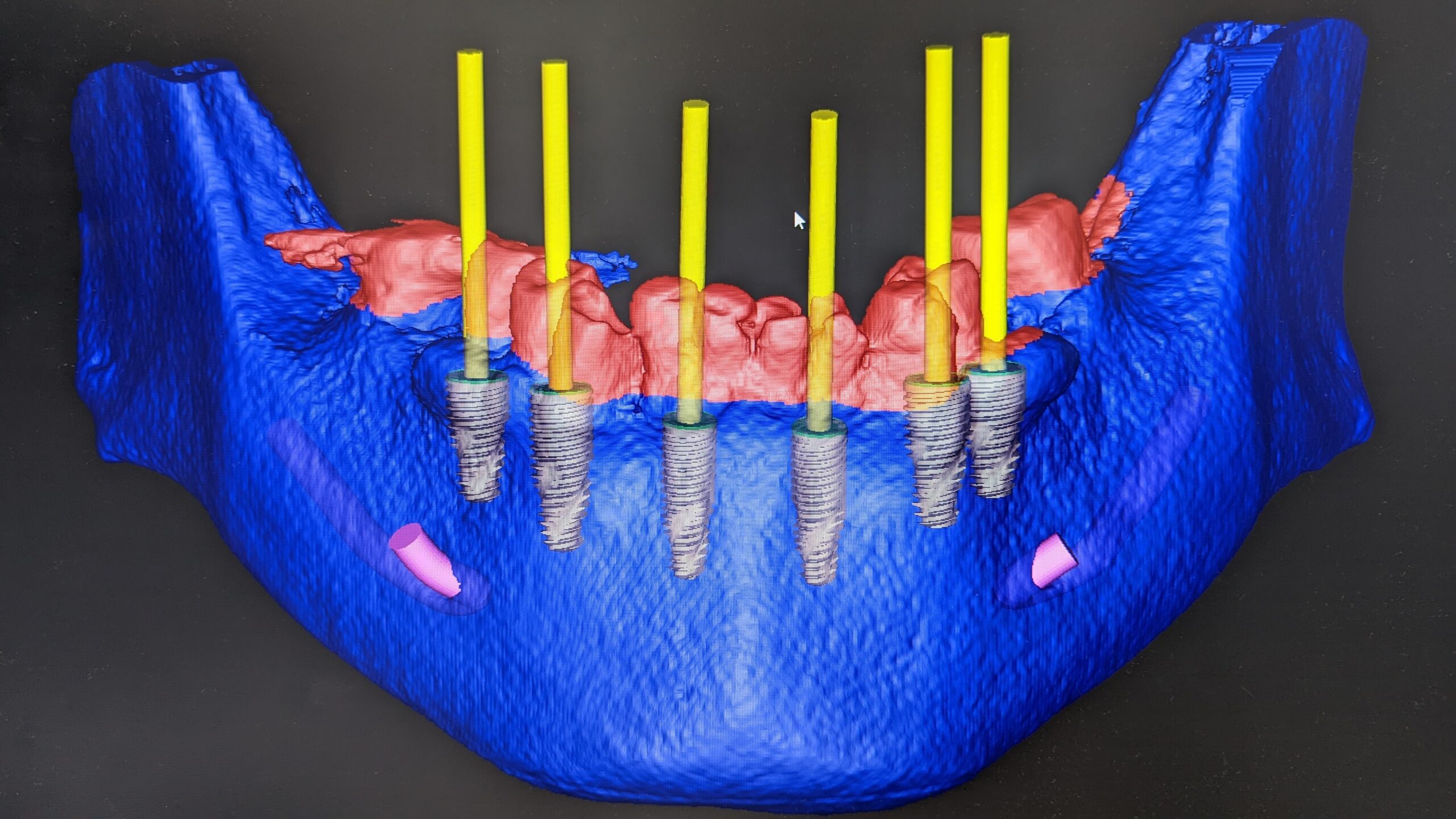 implant-image