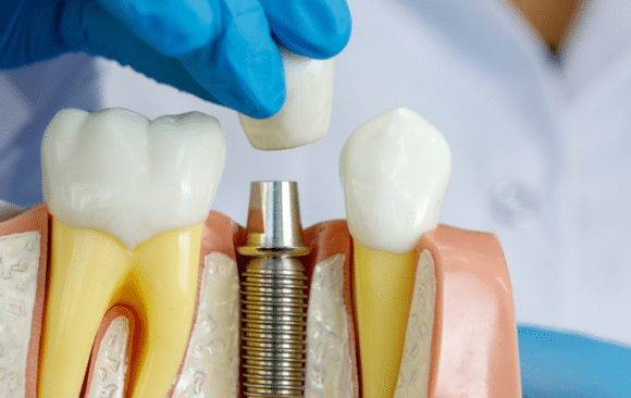 dental implant