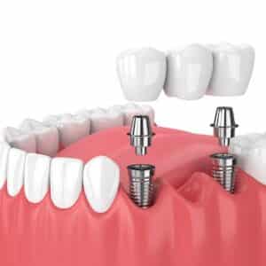 Protecting Your Dental Bridge: The Emergency Essentials