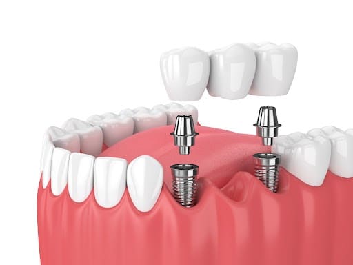 Protecting Your Dental Bridge: The Emergency Essentials
