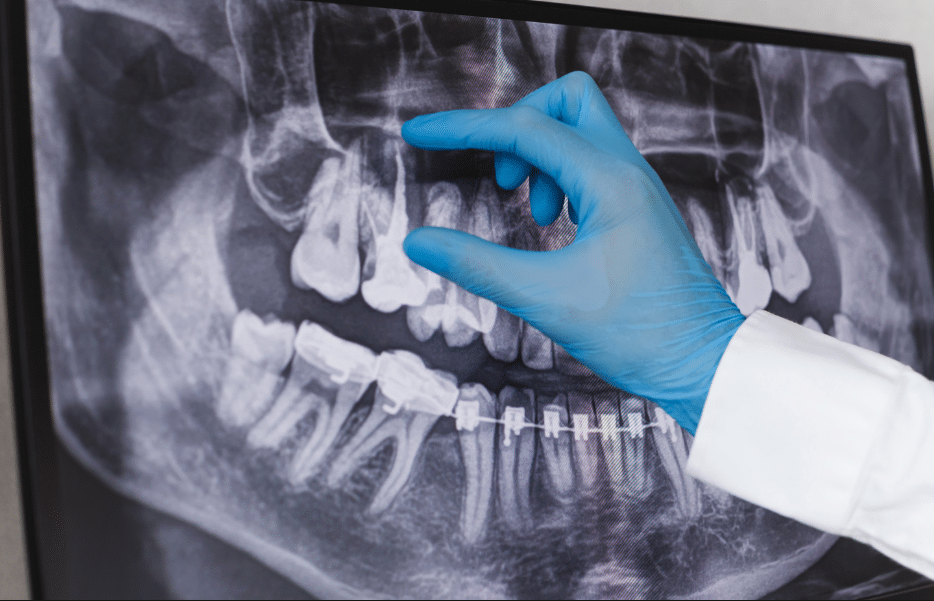 Dental Services for Root Canals and Digital Oral X-Rays